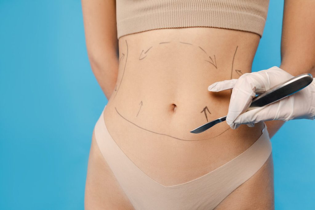 Abdominoplastia é a cirurgia certa para você?