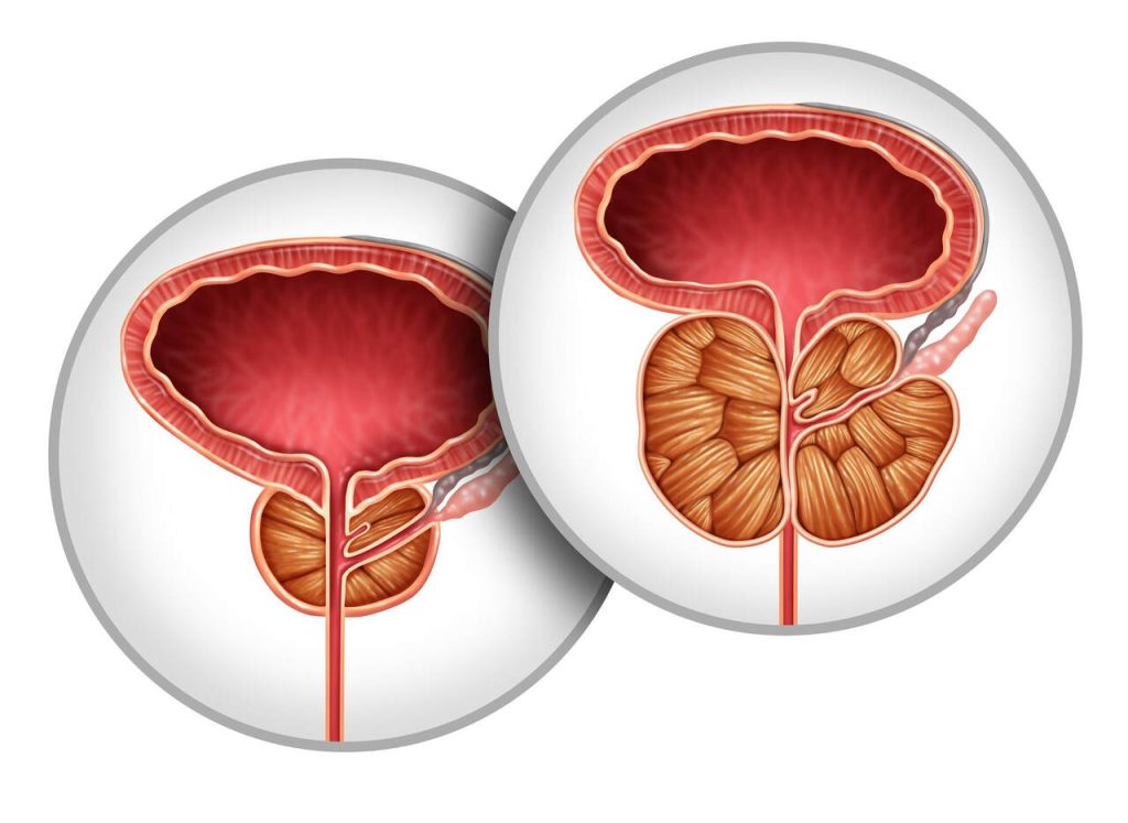 Aumento benigno da próstata: quando é indicada a cirurgia?