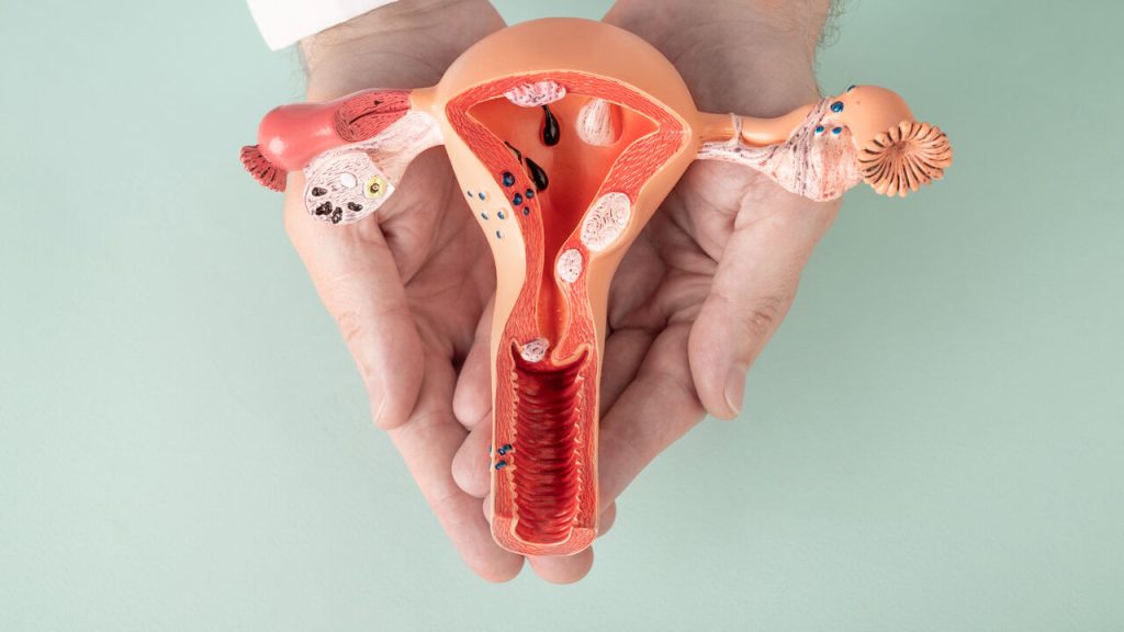 É possível ter miomas sem apresentar sintomas?