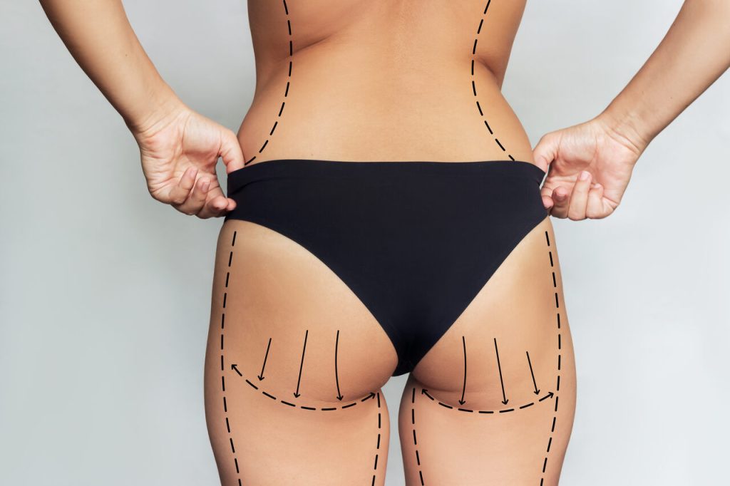 Lipoescultura não é só para definir o abdômen!