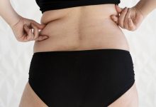 As gordurinhas na lateral da cintura te incomodam? Saiba mais sobre a Flancoplastia!