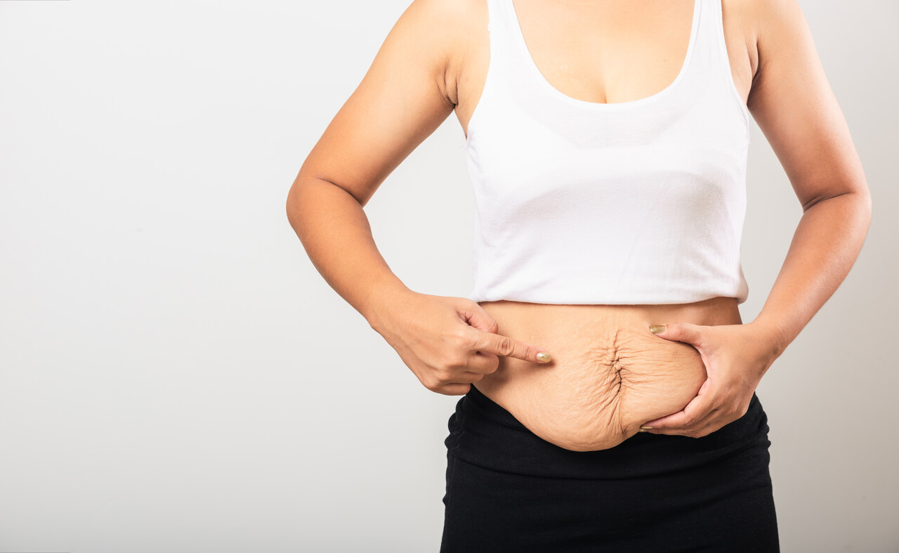Abdominoplastia em âncora Dr. Reyner Abrantes Stival detalha cirurgia indicada para grandes perdas de peso em Goiânia e Brasília