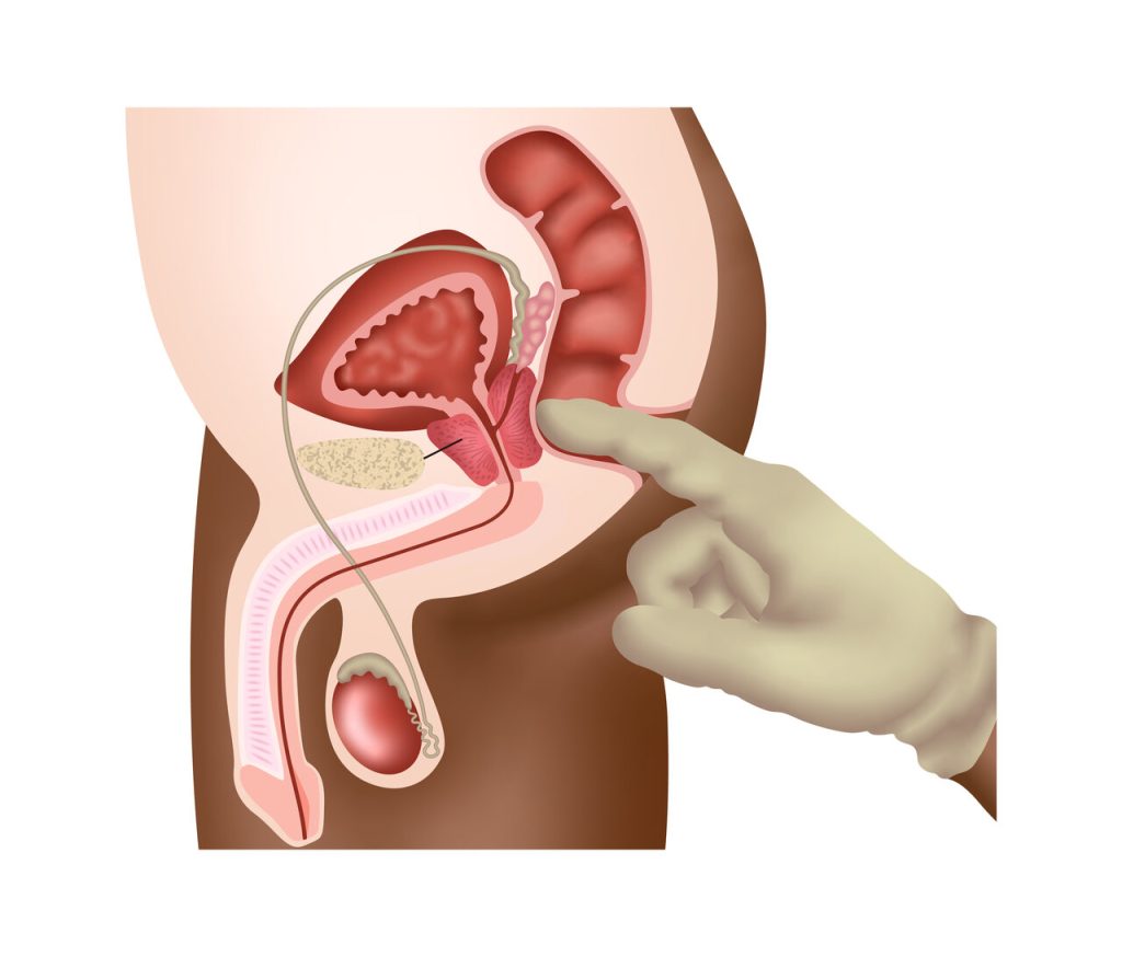 Dr. Marco Túlio Cruvinel, urologista em Goiânia, detalha os exames essenciais para detectar o câncer de próstata