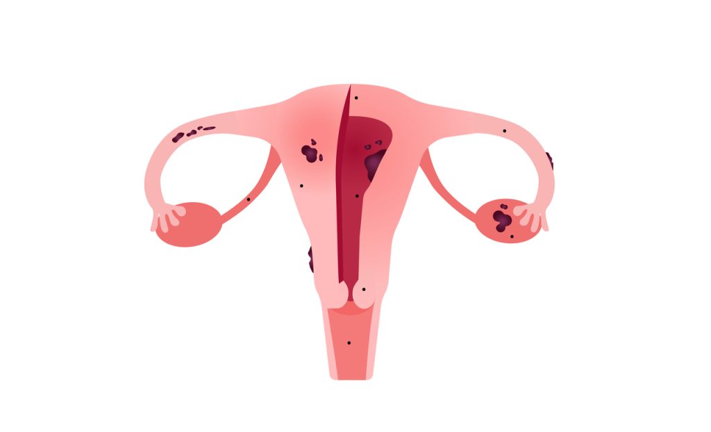 Você sabia que existem três tipos diferentes de endometriose
