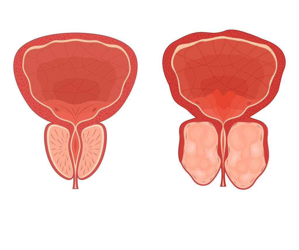 REZUM ou HoLEP Qual a melhor cirurgia para a hiperplasia prostática benigna (HPB