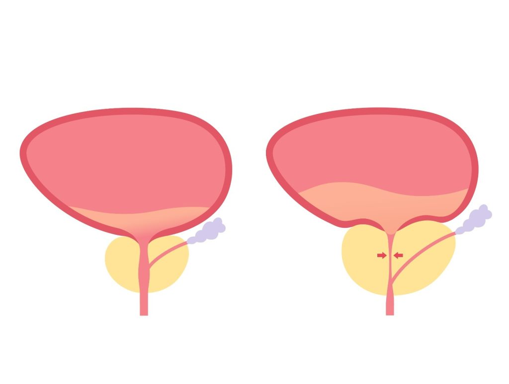 Sintomas parecidos, diagnósticos diferentes como saber se é HPB ou prostatite Ambas as condições afetam a próstata. Mas os sintomas, causas e riscos são muito distintos. E errar no diagnóstico pode atrasar a melhora e até piorar o quadro. 📌 Veja as diferenças ➤ Prostatite É uma inflamação (geralmente por infecção) que pode surgir de forma súbita – Dor na parte baixa do abdômen ou no períneo – Ardência ao urinar – Febre e mal-estar – Pode evoluir rápido e exige tratamento com antibióticos ➤ HPB (Hiperplasia Prostática Benigna) É o aumento benigno da próstata com a idade – Jato fraco de urina – Dificuldade para começar a urinar – Acordar várias vezes à noite para ir ao banheiro –Pode afetar a qualidade de vida ⚠️ O problema é que os sintomas se confundem — e o risco de erro no autodiagnóstico é alto. ✅ Por isso, o urologista pode solicitar exames como • Toque retal • PSA • Ultrassom • Urina tipo 1 🎯 Só com esses dados é possível indicar o tratamento correto — e devolver saúde e tranquilidade ao paciente. 💬 Já sentiu algo parecido ou conhece alguém que sente